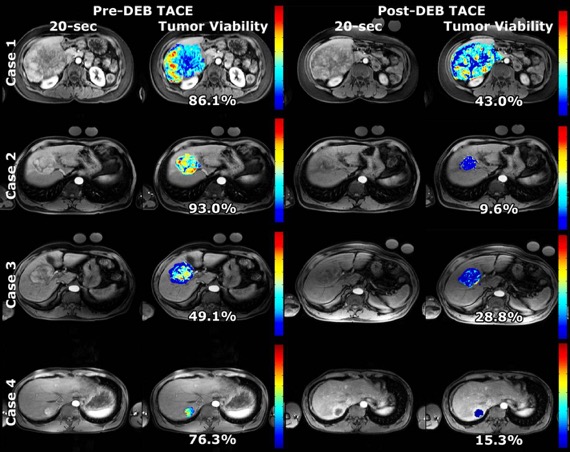 3D quantitative therapy response assessment